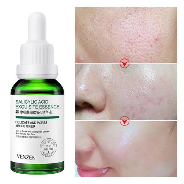 Kit Bioaqua - Ácido salicílico